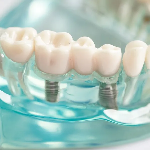 Model of dental implants